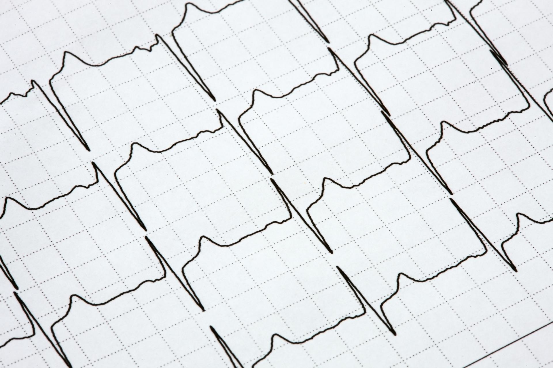 EKG-Linien zur Herzüberwachung | arterielle Durchblutungsstörung	